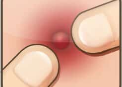 تحميل لعبة التخلص من البثور والرؤوس السوداء Pimple Popper Lite للآيفون